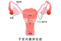 反流性食管炎癥狀（反流性食管炎癥狀有哪些反應(yīng)）