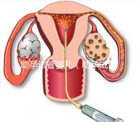 助孕試管嬰兒（助孕試管嬰兒保險）