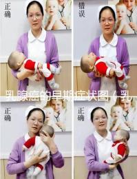 乳腺癌的早期癥狀圖（乳頭狀瘤早期圖片）