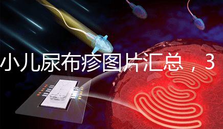 小兒尿布疹圖片匯總,3種類型癥狀大不一樣