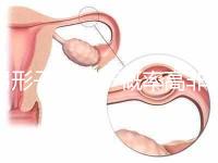 弓形子宮流產概率高非個例！罪魁禍首是這個原因