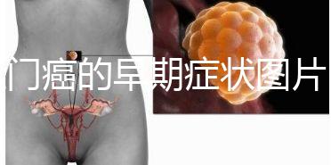 肛門癌的早期癥狀圖片（肛門有個(gè)肉球圖片）