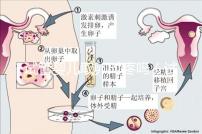 試管嬰兒取卵時(shí)疼嗎（試管嬰兒取卵時(shí)疼嗎,取卵多長(zhǎng)時(shí)間才是移植）