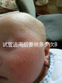 試管進周后要做多少次B超？需要檢查什么？進來看看